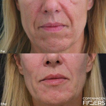 Kvinde før og efter opbygning af kinder og korrektion af asymmetri med Restylane. 8 år imellem billederne.