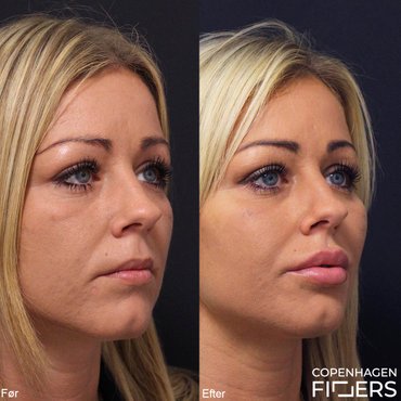 Kvinde før og efter Restylane behandling af kindben og læber.