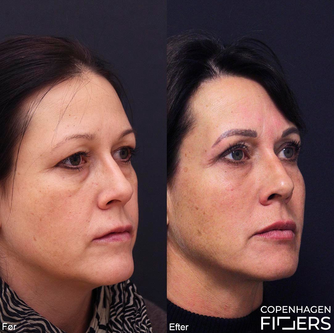 Filler I Kindben Hello gothenburg the fillers club is back with the hottest offer this year. filler i kindben