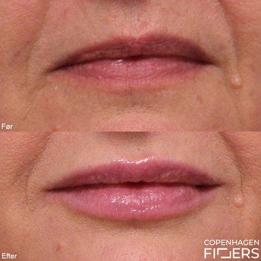 Kvinde før og efter korrektion af læbeasymmetri med Restylane Kysse ved hjælp af en forsigtig læbeforstørrelse.