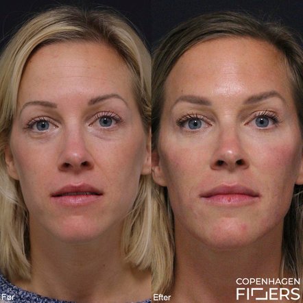 Kvinde før og efter filler behandling til mørke rande og kindben. 5 år imellem billederne.