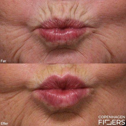 Kvinder før og efter Restylane behandling af læber for at mindske rynker omkring munden.