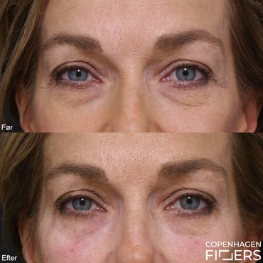 Kvinde før og efter filler behandling for mørke rande under øjnene.