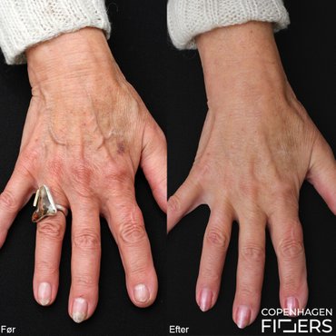 Restylane Skinbooster til hænder. Giver en fin og naturlig fylde og genskaber de smukke hænder. Før og efter. 