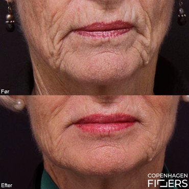 Ældre kvinde før og efter Restylane Skinbooster og læbeforstørrelse.