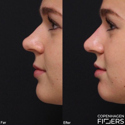 Kvindes før og efter Restylane behandling til næse som nu er glat og lige.