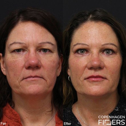 Kvinde før og efter behandling med Restylane til læber,  mundvige og kinder