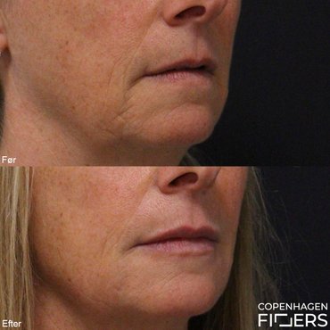 Kvinde før og efter en Restylane behandling af læber, mundvige samt rynker omkring munden..